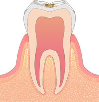 むし歯治療 c1
