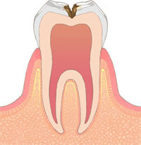 むし歯治療 c2