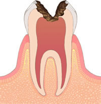 むし歯治療 c3