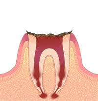 むし歯治療 c4